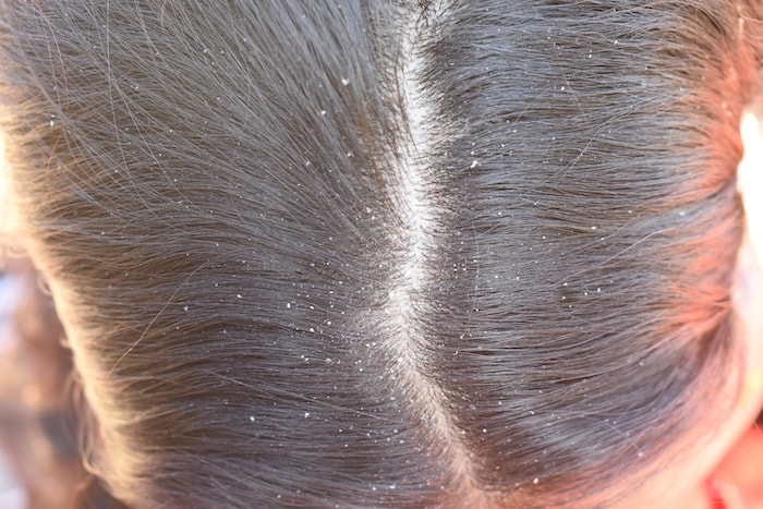 Close view of a scalp with flakes along the hairline