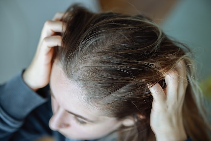 Close view of a dry, irritated scalp
