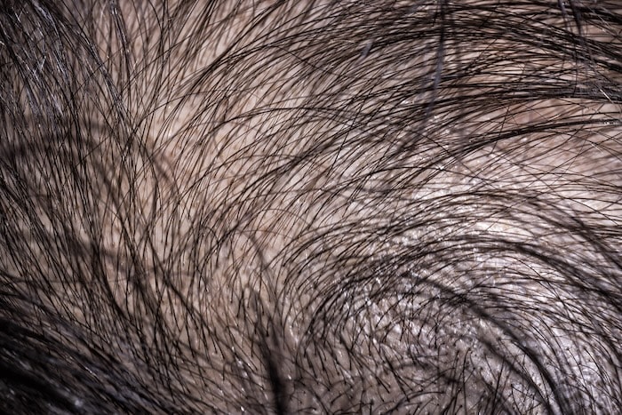 Close view of a scalp with visible hair thinning