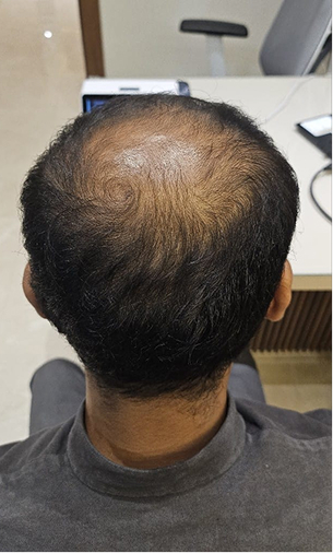 Scalp before and after a MoArae ritual, first result, after