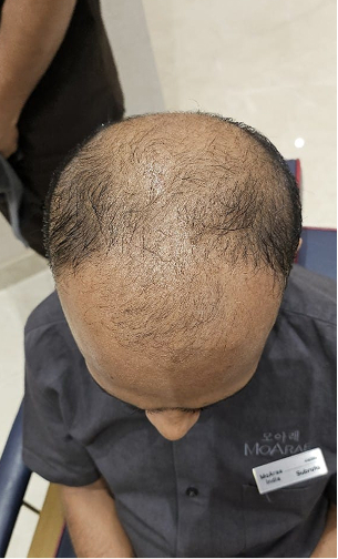 Scalp before and after a MoArae ritual, second result, before